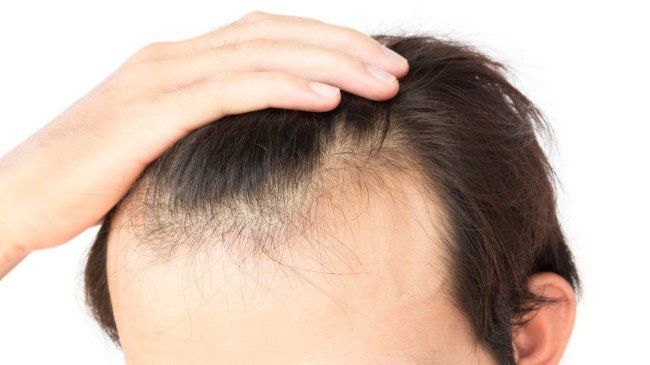 تقنية dhi لزراعة الشعر