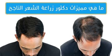 نصائح الخبراء لاختيار دكتور زراعة الشعر الأفضل