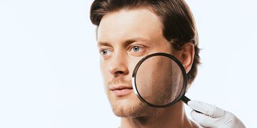 علاج تصبغات الوجه عند الرجال