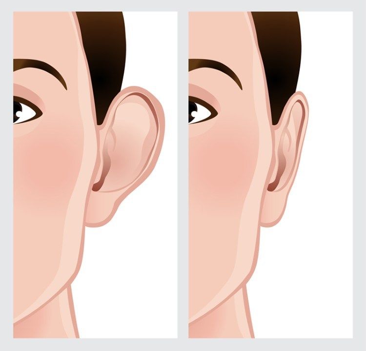 رسومات قبل و بعد تصغير الاذن