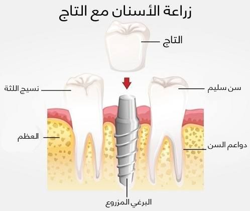 زراعة الأسنان مع التاج