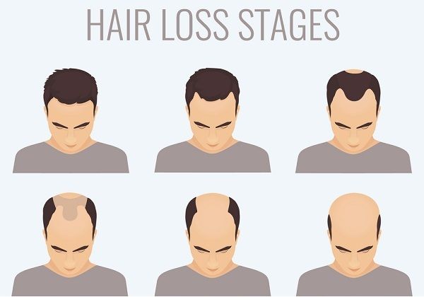 مراحل تساقط الشعر عند الرجال
