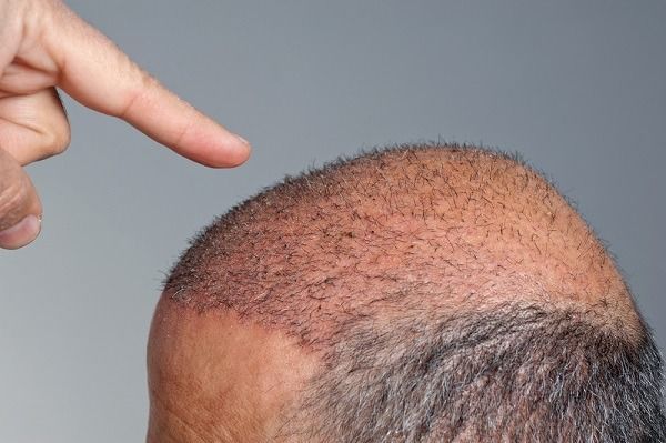 زراعة الشعر في البحرين الأسعار وأفضل الأطباء والمراكز وأكثر تجميلي