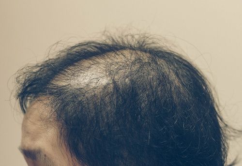 لي أول يفسد تساقط الشعر عند النساء الاسباب والعلاج بالتفصيل بخلطة مميزة bsssem com
