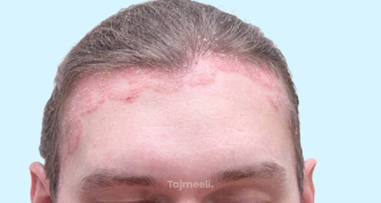 اضرار زراعة الشعر | مخاطر زراعة الشعر واثار العملية | تجميلي