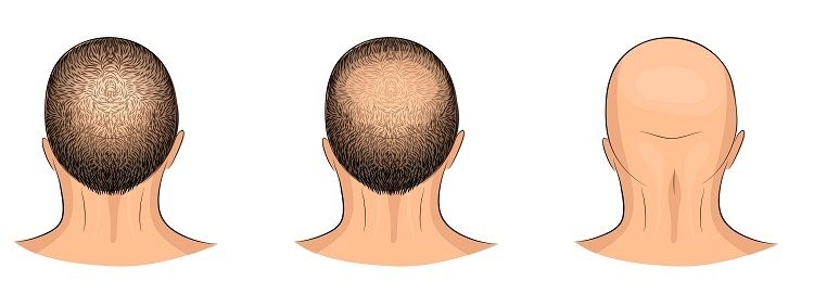 علاج تساقط الشعر للرجال أفضل الطرق والاسباب تجميلي