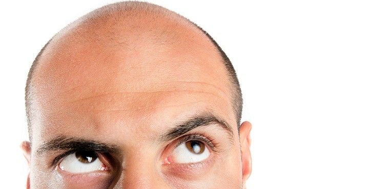 اسباب تساقط الشعر عند الرجال