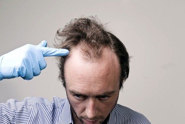 علاج الشعر الخفيف من الامام للرجال