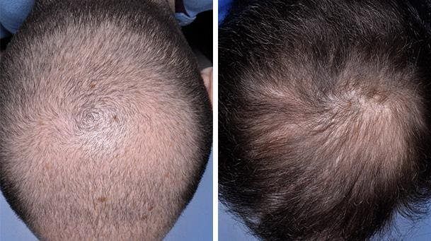 علاج تساقط الشعر الوراثي عن طريق الجراحة