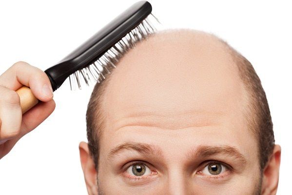 علاج تساقط الشعر عند الرجال من الامام