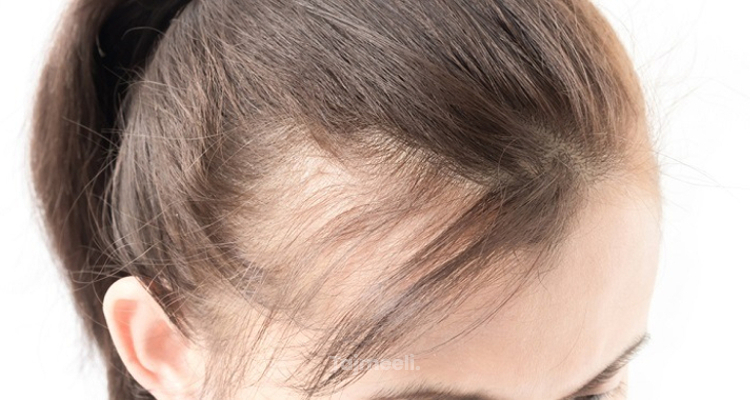علاج لتساقط الشعر