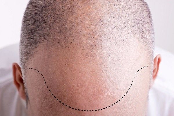 اسعار زراعة الشعر في تركيا اسطنبول وأنقرة وانطاليا وازمير تجميلي