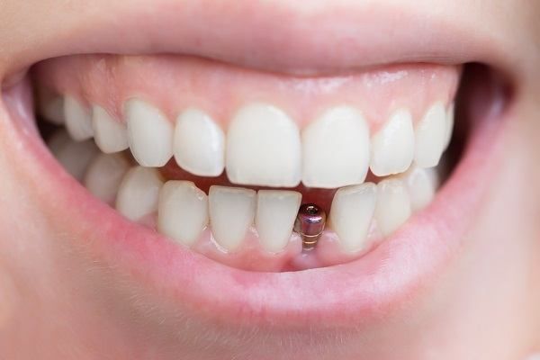 المرشحون لتقنية تركيب الأسنان الفورية