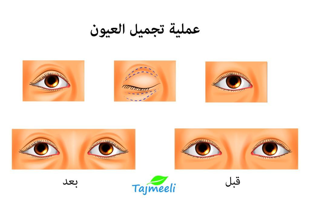 عملية تجميل العيون