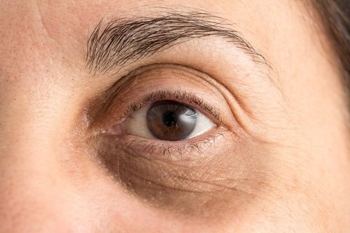 علاج جوفاء تحت العين الأسباب والعلاج والمزيد من مستحضرات التجميل