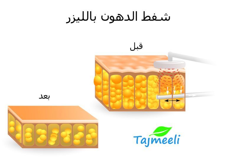 عملية شفط الدهون بالليزر في قطر