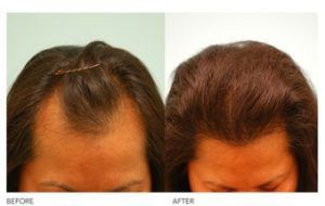 هل عمليات زراعة الشعر ناجحة ؟