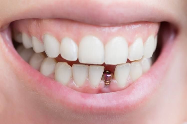 أهم مميزات زراعة الأسنان في أبوظبي
