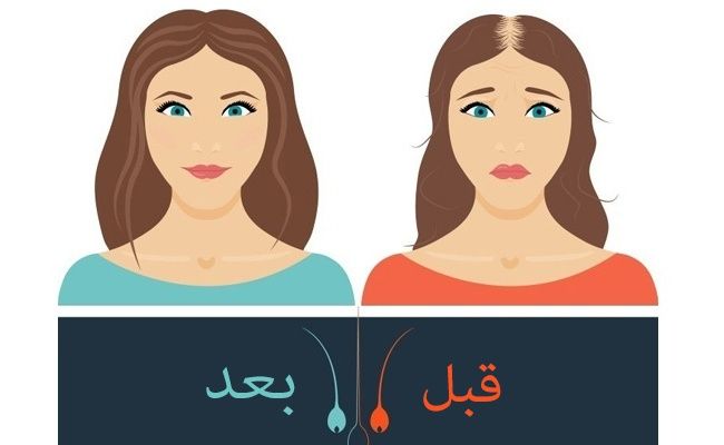 مميزات وعيوب حقن بلازما الشعر بالقاهرة