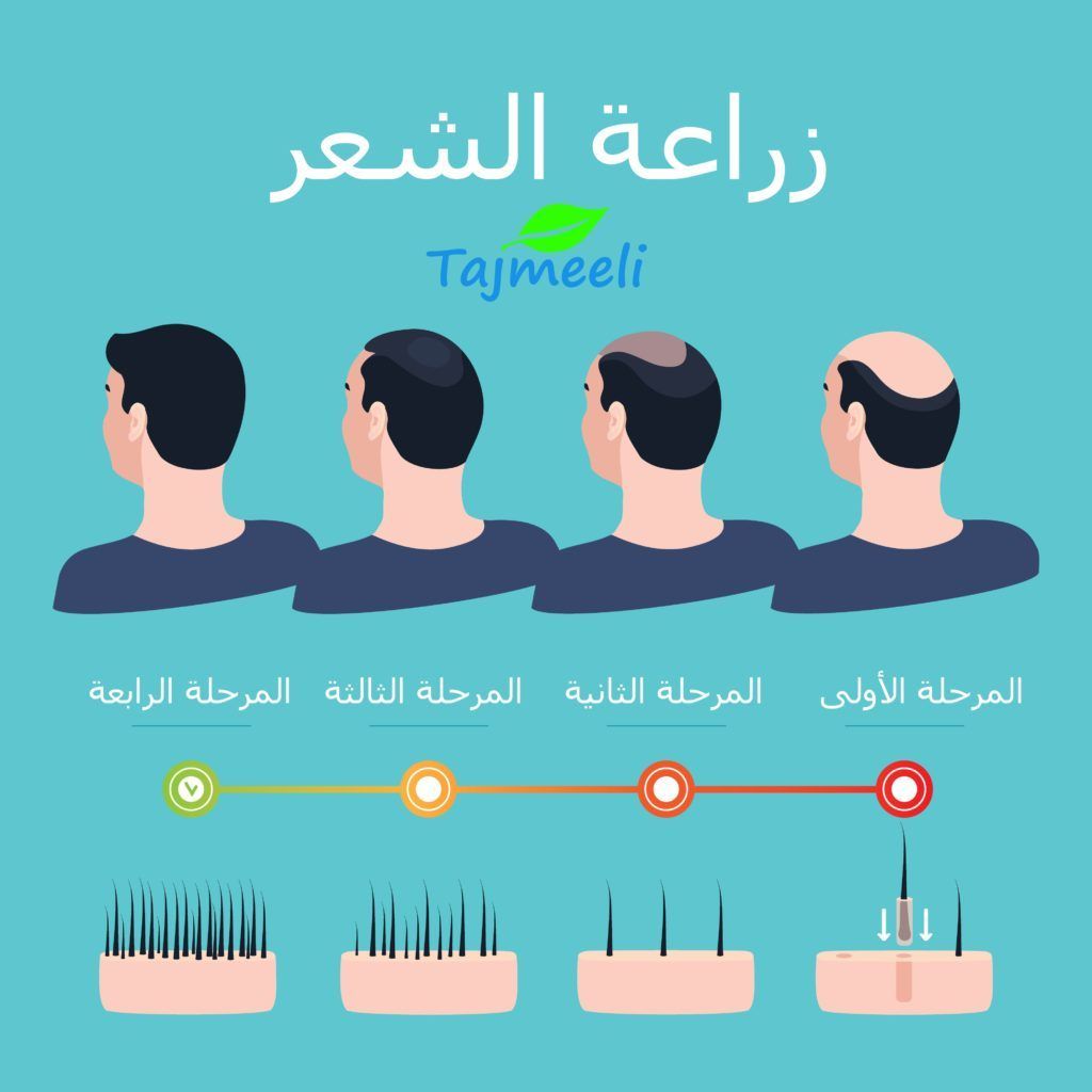 عمليات زراعة الشعر في قطر