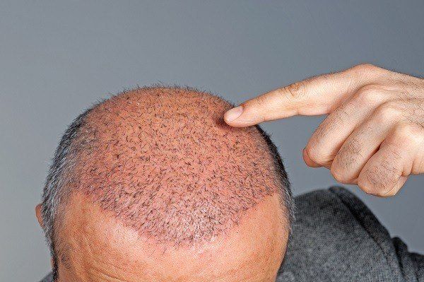 علاج الصلع زراعة الشعر