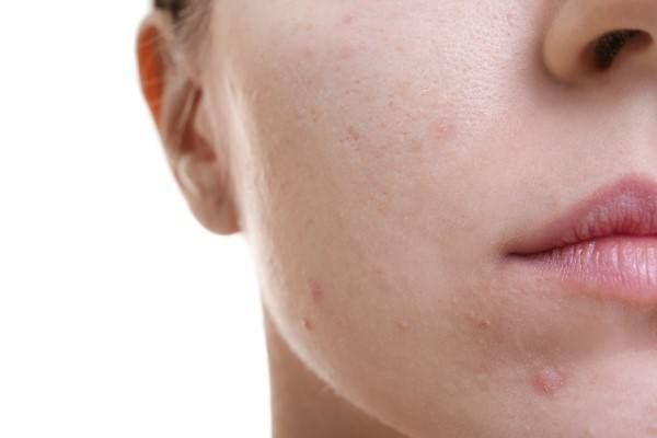علاج حبوب الوجه الهرمونية المنشأ