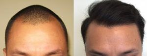 تجربة زراعة الشعر قبل وبعد