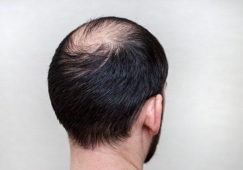 سبب تساقط الشعر عند الرجال