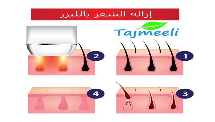 عمليات إزالة الشعر بالليزر في سلطنة عمان