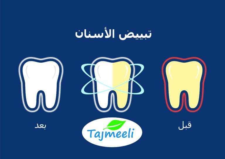 عملية تبييض الاسنان في تونس