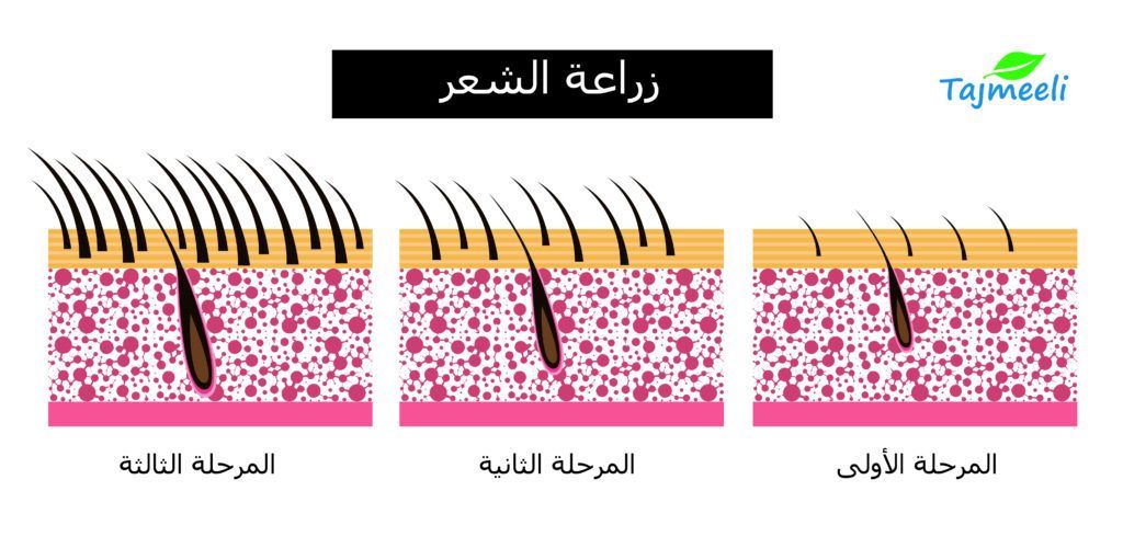 عملية زرع الشعر في جدة