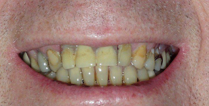 ما هو اصفرار الاسنان وما هي أسبابه