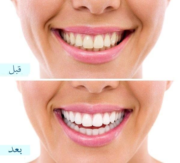 مميزات وعيوب تبييض الاسنان في تونس