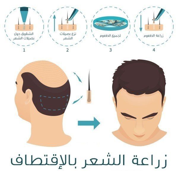 تقنية زراعة الشعر بالاقتطاف (FUE)