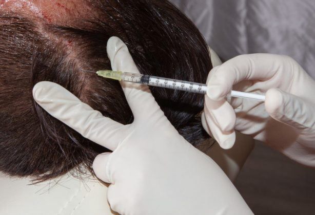 تقنية زراعة الشعر بالخلايا الجذعية آمنة