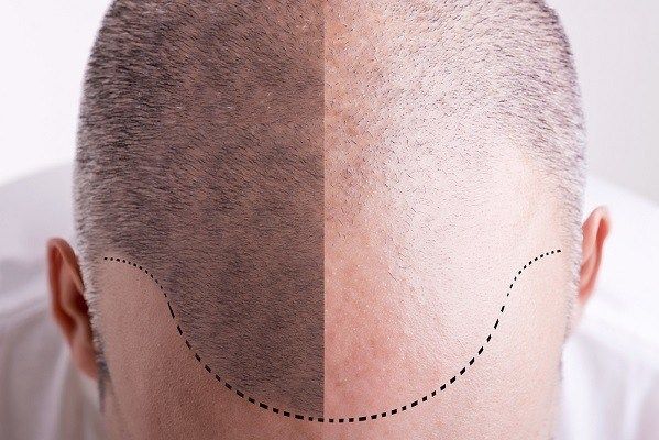 جراحة زراعة الشعر لعلاج نمط التساقط الوراثي