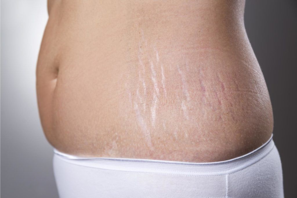 علامات تمدد الجلد أثناء الحمل وطرق علاجها