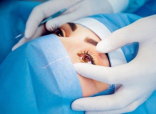 كيف تختار طبيب التجميل المناسب لإجراء عملية توسيع العيون؟