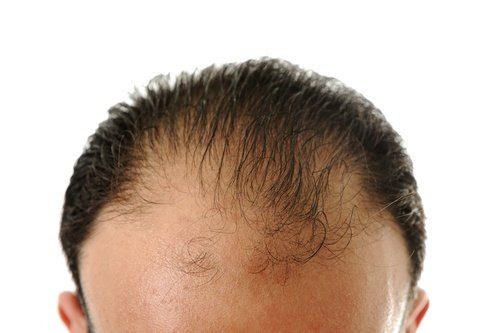 مخاطر مترتبة على زراعة الشعر بالليزر