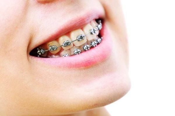 هل عملية تركيب تقويم الأسنان مؤلمة ؟
