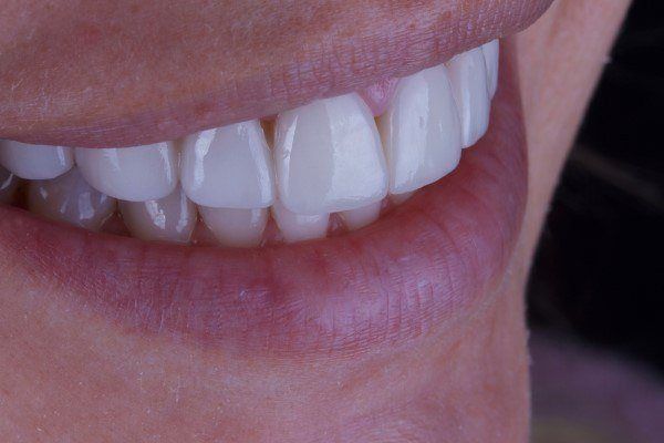عدسات الاسنان في جدة والعيادات واسعارها تجميلية