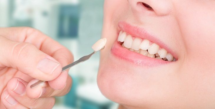 خطوات عملية تركيب فينير الأسنان