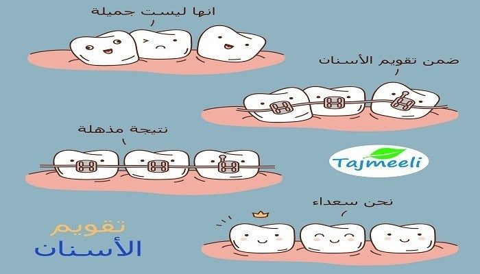 علاج تفرق الأسنان التقويم والفينير والتكلفة تجميلي