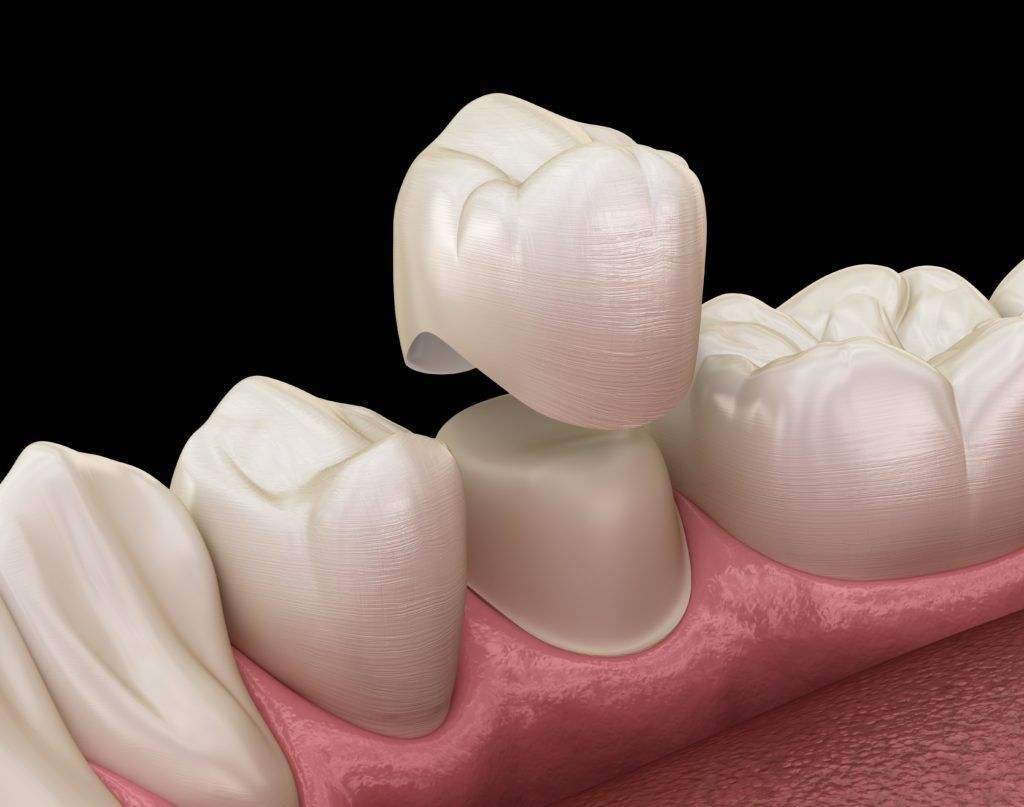 استخدامات تركيبات الزيركون للأسنان