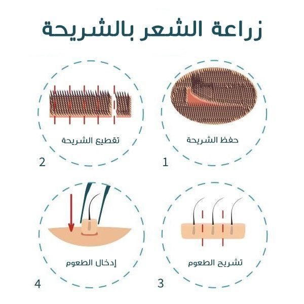 عمليات زراعة الشعر في مصر - تقنية الشريحة 