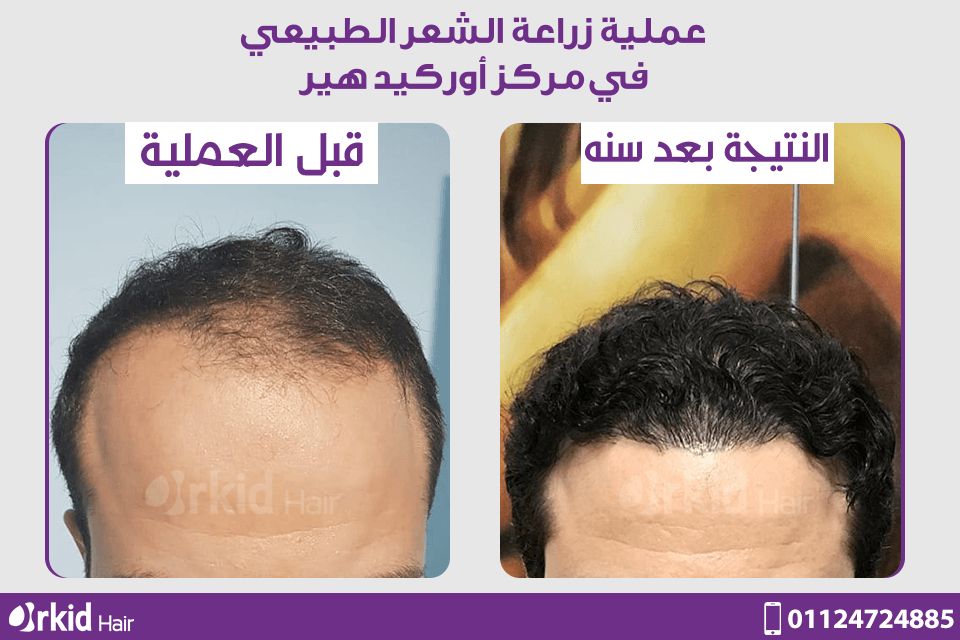 عملية زراعة الشعر بعد السنة