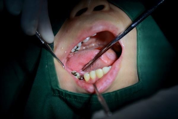 ما هي اضرار تركيب الاسنان الثابتة ؟