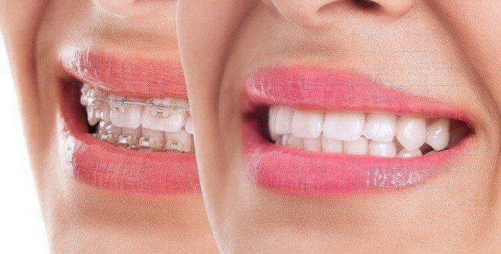 مشاكل تقويم الاسنان الثابت