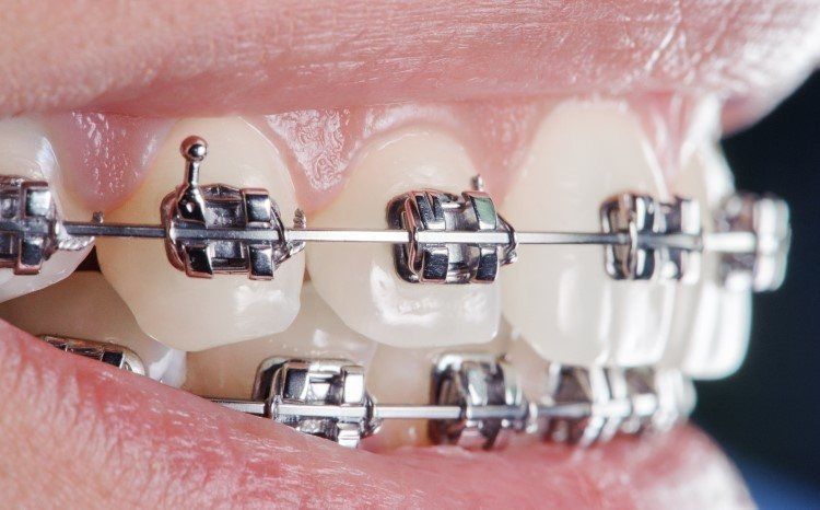 مكونات تقويم الاسنان الثابت