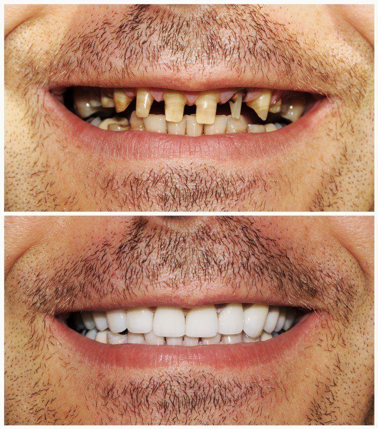 نتائج تركيب الاسنان